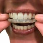 cuando poner ferula dental